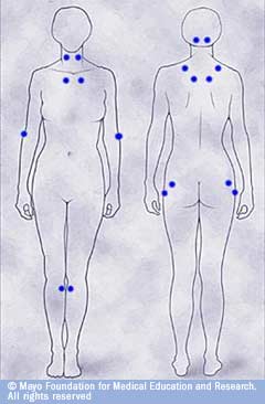 Fibromyalgia Tender Points